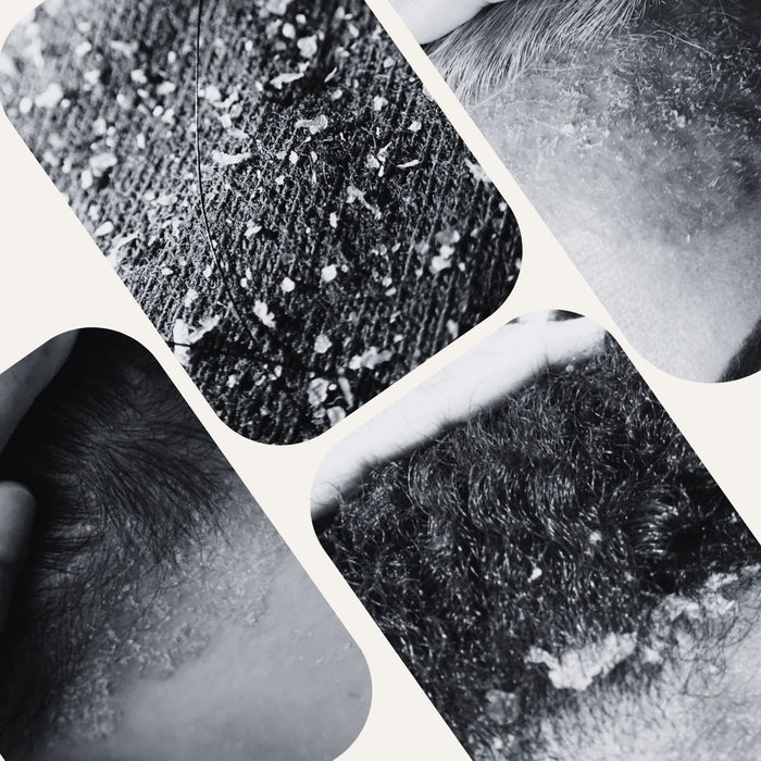 How To Tell If You Have Dandruff or Seborrheic Dermatitis?